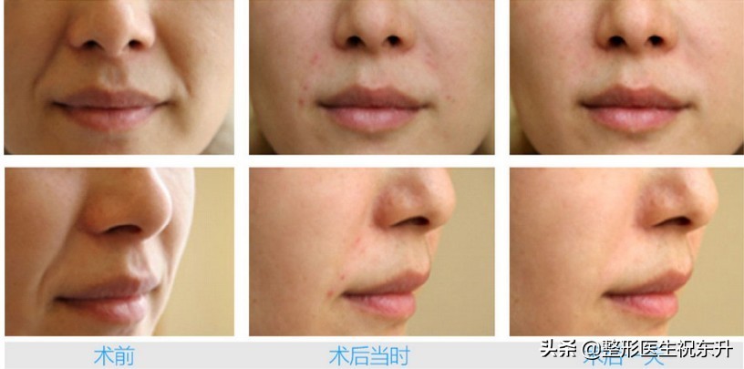 玻尿酸和肉毒素填充法令纹全过程,法令纹应该打肉毒素还是玻尿酸