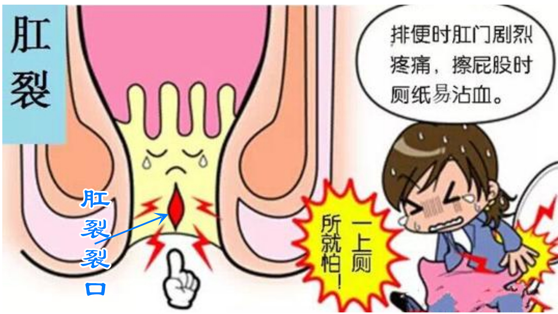 不公平!“痔疮”说:凭什么“肛裂”的锅要由我来背呢