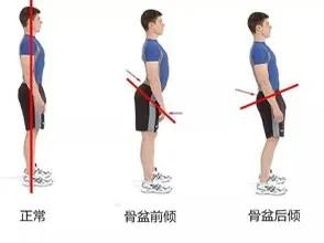骨盆前倾的评估与解决,骨盆一边前倾一边后倾怎么测试