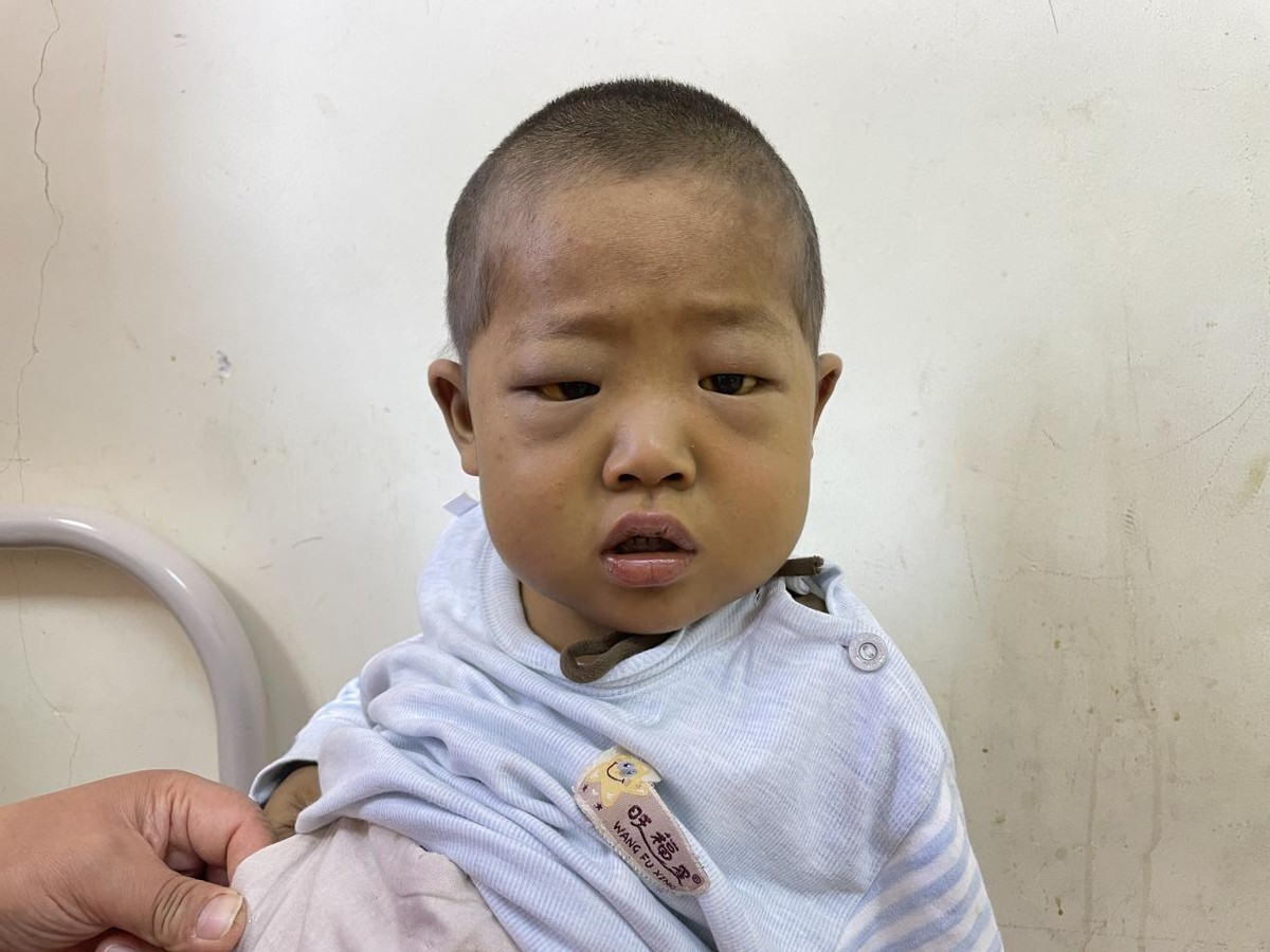 出生一周的婴儿眼睛有点黄,刚出生五天的婴儿眼睛黄