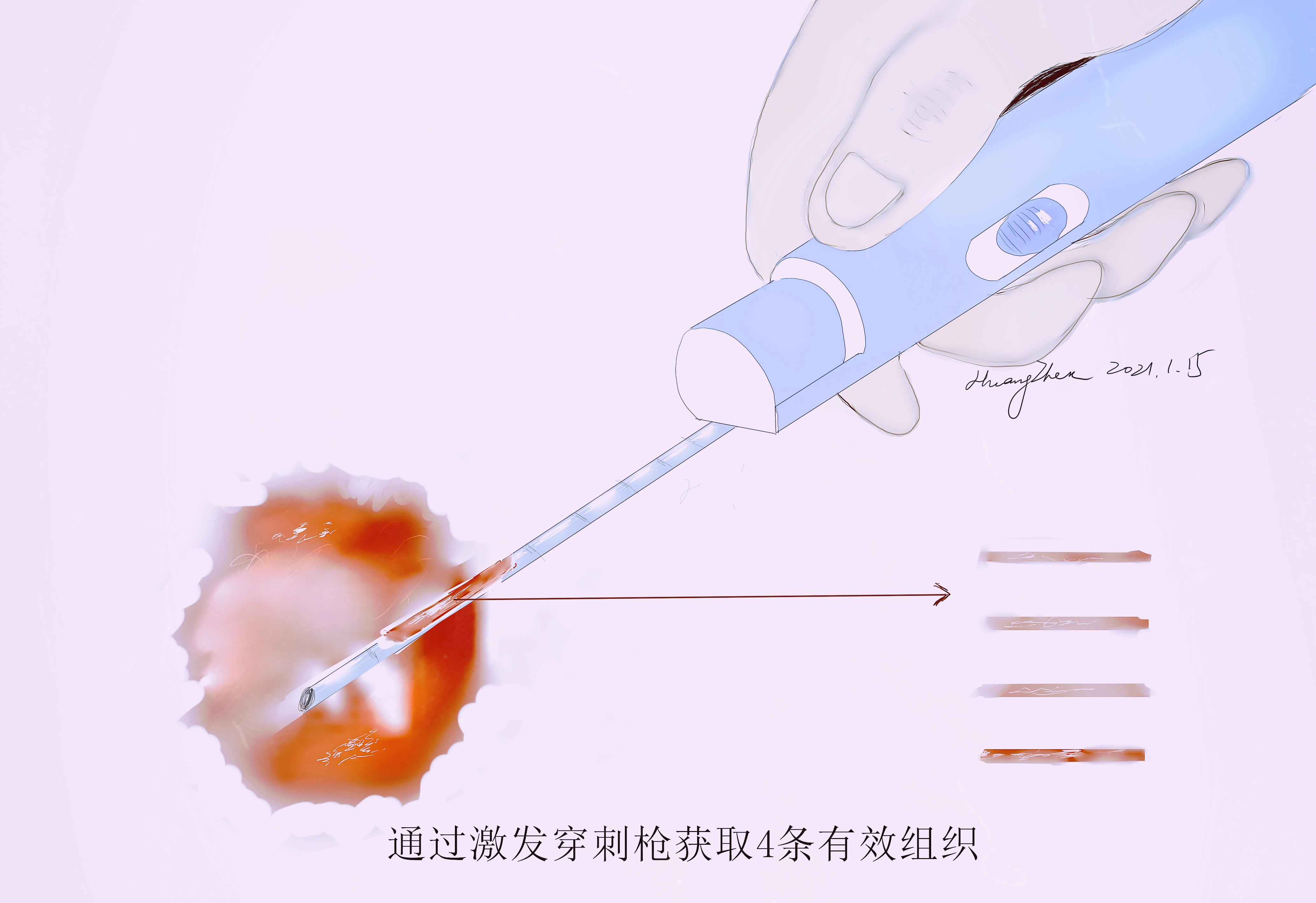 乳腺肿块活检穿刺多少钱,乳腺穿刺活检为肿瘤病变