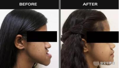 鼻基底严重法令纹很深怎么遮盖,鼻基底凹陷法令纹瘦下去会改善吗