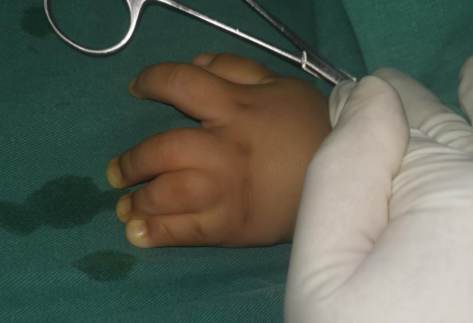 并指畸形免植皮案例,并指畸形