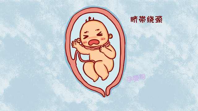 脐带绕颈怎么办如何快速解决,脐带绕颈有危险吗有什么建议