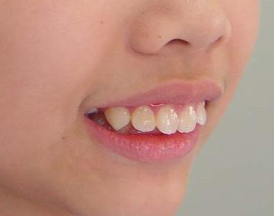 宝宝爱咬上嘴唇如何纠正,小孩喜欢咬嘴唇睡觉变龅牙