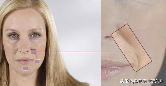 法令纹显老10岁三种方法帮助改善,脸上有法令纹最好解决的办法