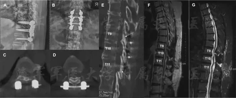 胸椎黄韧带骨化的治疗方法,胸椎黄韧带骨化症手术效果如何