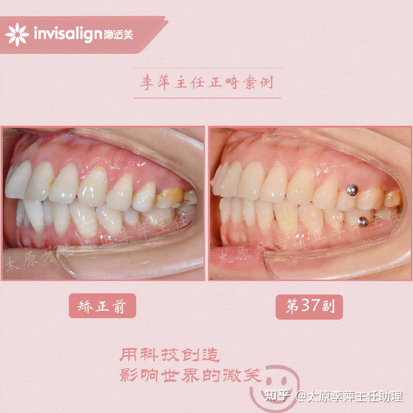 太原牙齿矫正靠谱吗,太原成人隐形牙套牙齿不齐