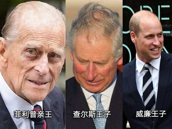 有了这个神器，英国人的脱发有救了？