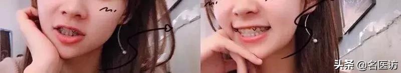 戴牙套2年不戴保持器反弹案例,戴牙套成功案例不戴保持器