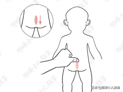 宝宝2岁青蛙肚要多久才能消失,儿童青蛙肚怎么解决