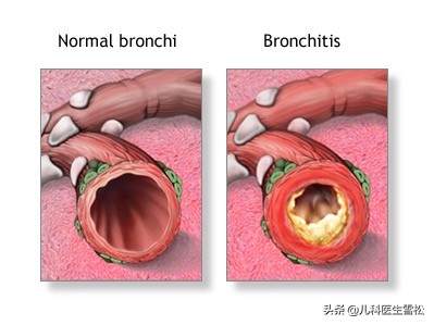 宝宝双肺声音粗是怎么回事,肺炎后呼吸音粗是怎么回事