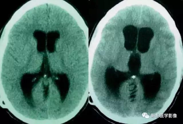 脑室为什么会扩张,脑室为什么会变小