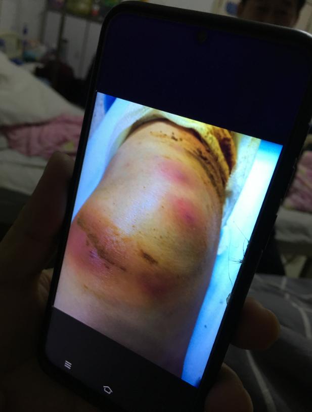 针灸感染,河南诊所针灸感染