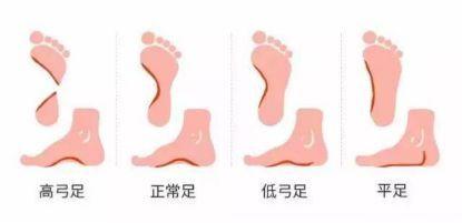 扁平足脚跟突出选什么鞋,拇外翻患者如何选择合适的鞋