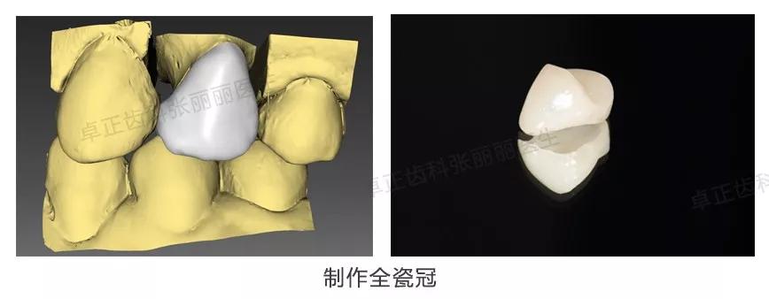 牙齿楔状缺损修复图片,牙齿楔状缺损修复大概多少钱