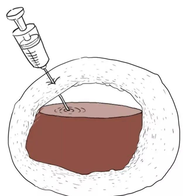 卵巢出现巧克力颜色块,巧克力囊肿长在卵巢上怎么治