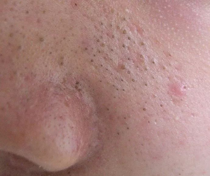 黑头反复的长还用清理吗,黑头反复长脸上老出油