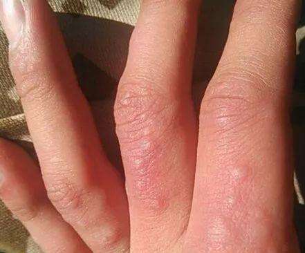 夏季手上起小水泡是什么情况,夏天手上长小水泡怎么根治