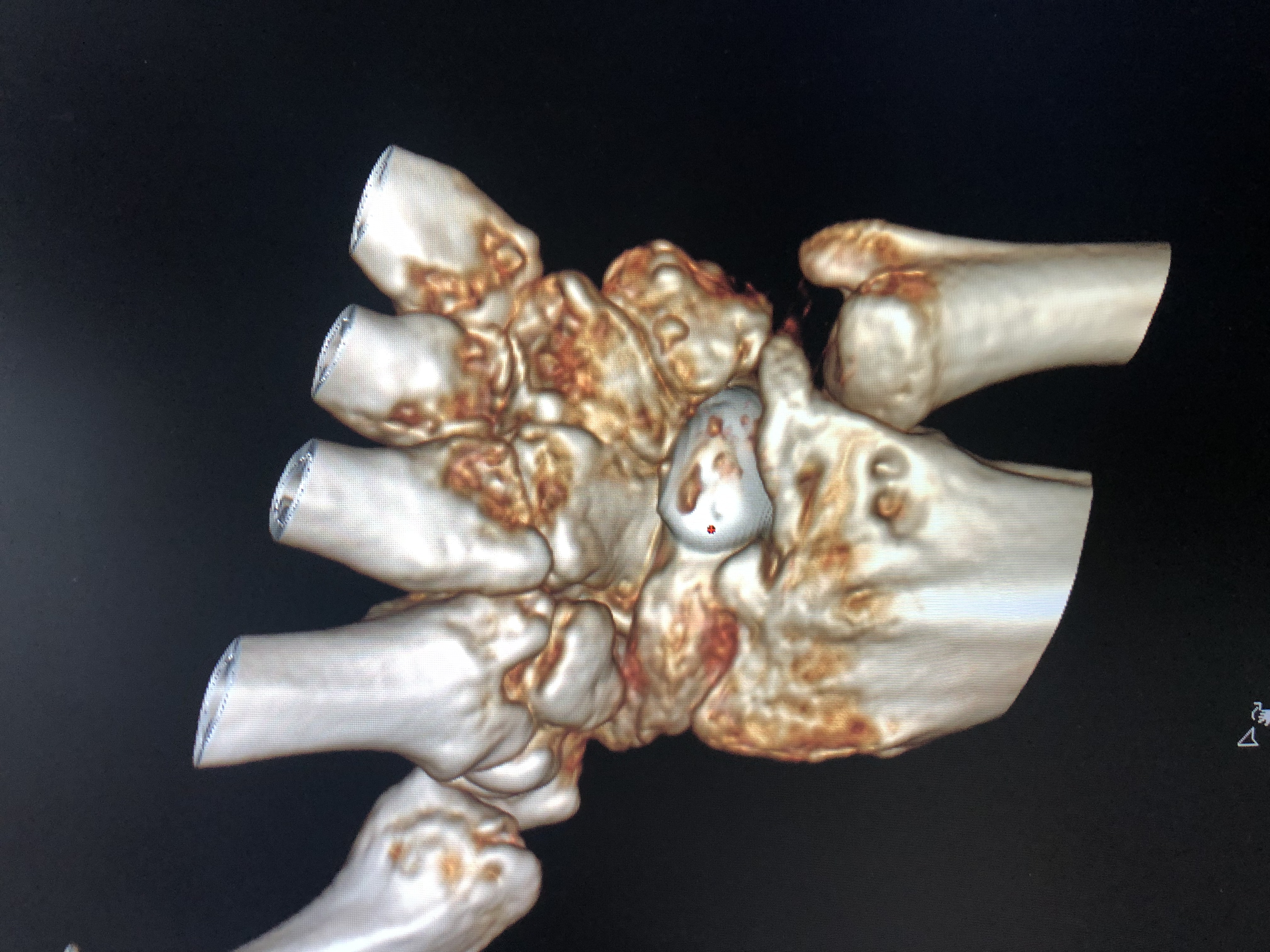 髋臼骨折3d打印效果怎么样,骨折后无法复位怎么办