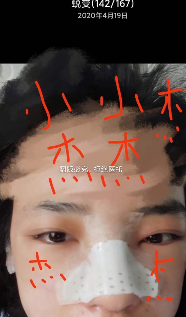长沙隆鼻1-7天恢复过程图,长沙做假体隆鼻手术多少钱