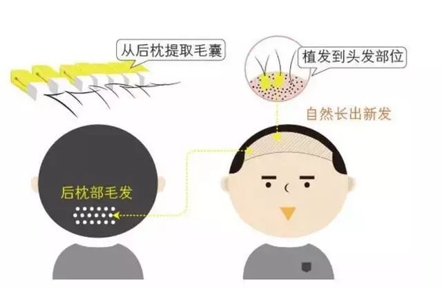 雄性激素脱发怎么自救,自救脱发最有效的方法