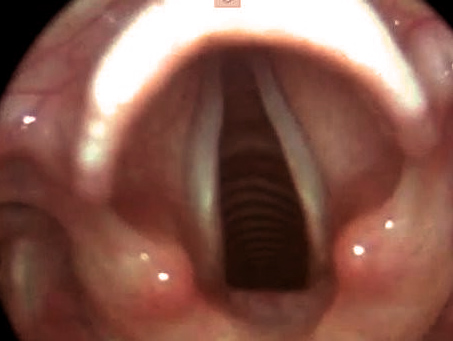 鱼刺卡喉咙没感觉了还用检查吗,小鱼刺卡喉咙吞咽没感觉