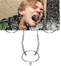 肾移植可以做结石手术吗,移植肾结石