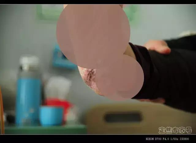 这些癌变信号别大意,这些癌前病变千万别忽略