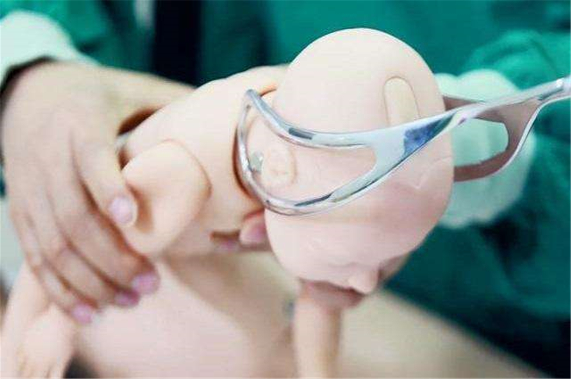 宝宝产钳的印子,宝宝产钳印