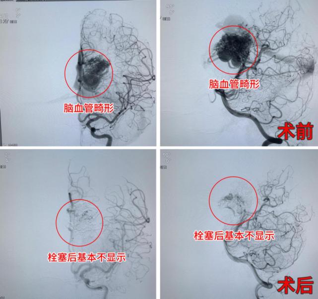 脑出血介入栓塞术后遗症,孩子脑出血30mm保守治疗能恢复吗