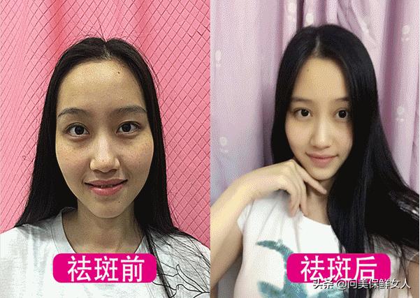 祛斑真实案例内调,祛斑案例说说