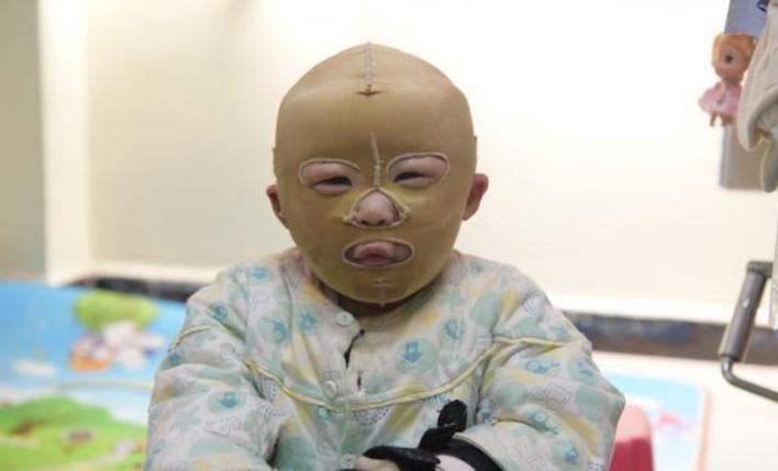 孩子被烫伤母亲自责了,孩子被开水烫伤大人自责