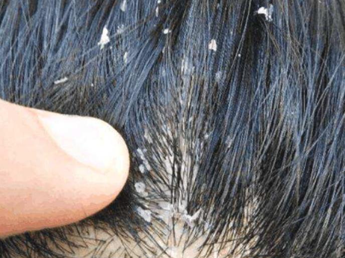 头发油腻用什么洗发水去除头螨,头皮痒头屑多有头螨用什么洗发水