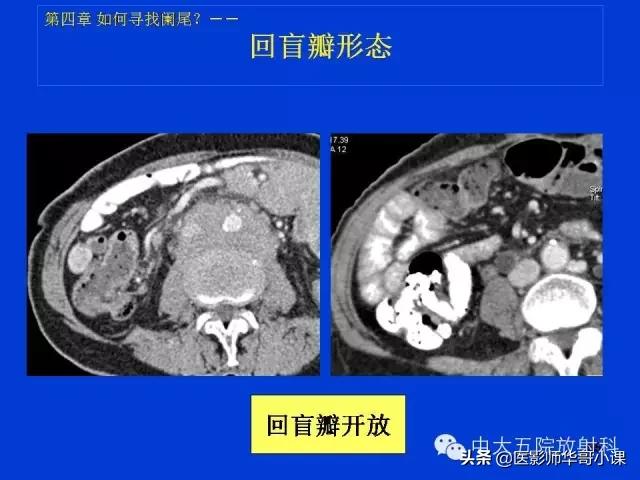 阑尾炎课件,阑尾炎的超声课件