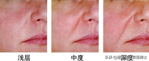 祛除法令纹最有效最自然的方法,淡化法令纹真正有效果的方法