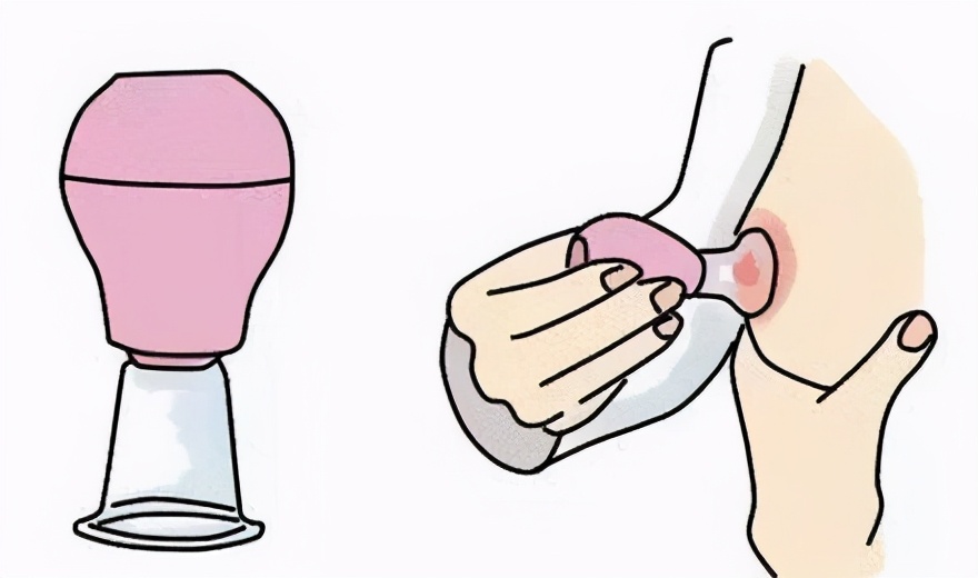 捂脸！乳头像火山口般凹陷，会影响哺乳功能吗