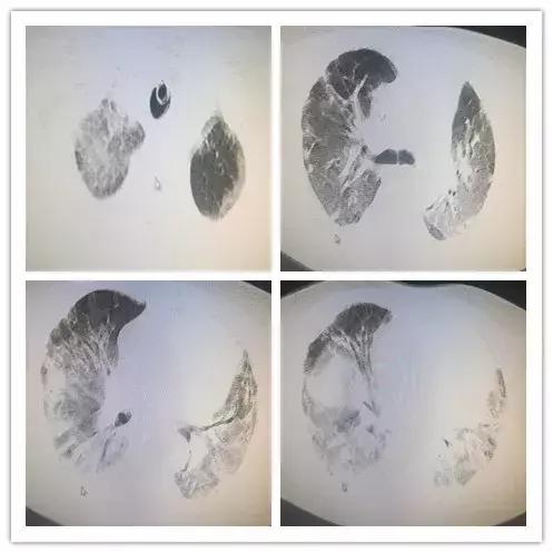 罕见病误诊的真实案例,误诊漏诊导致病人肿瘤癌变