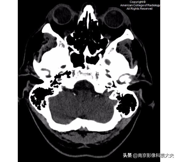22岁男子眼睛意外失明,中年男子突然右眼失明半小时
