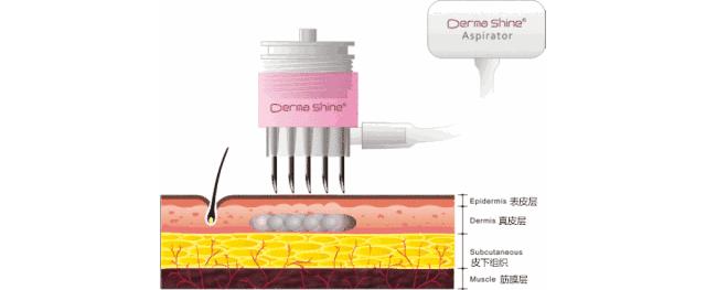 美容微针与滚针的区别在哪,最新技术的微针