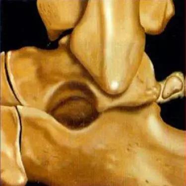 踝关节撞击症问诊,踝关节撞击综合征的x线表现