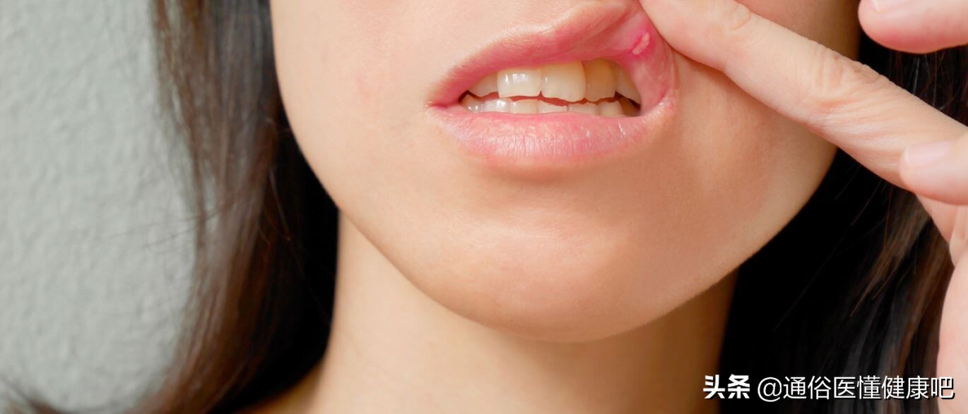 嘴里有伤口可以用盐水漱口吗,嘴巴破洞了怎样好得快