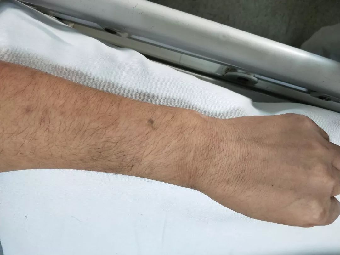 为什么拔了留置针还疼,拔完留置针是什么感觉