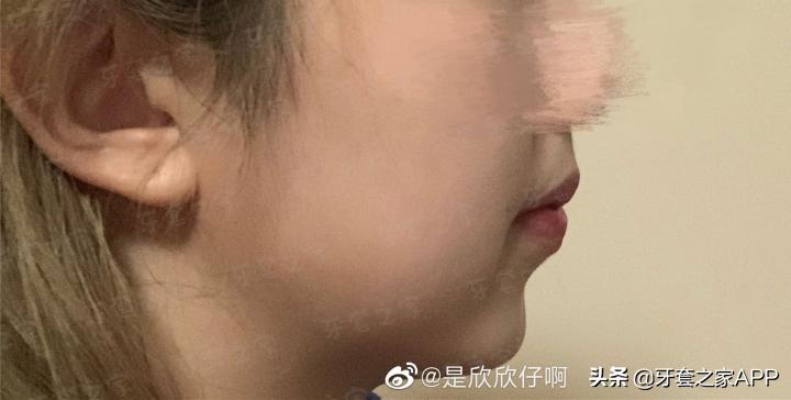不靠整容怎么改变下巴后缩？看这里