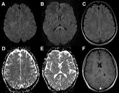 胼胝体有什么症状,胼胝体形态较小可以治疗吗