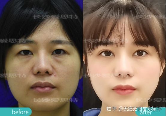 做个双眼皮就能变美,怎么贴双眼皮的时候更自然更好看