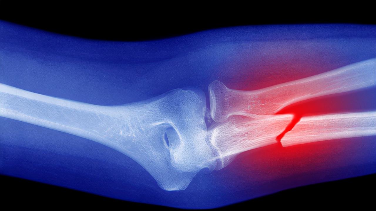 骨质疏松胸椎压缩性骨折能补钙吗,骨折骨质疏松吃什么好得快