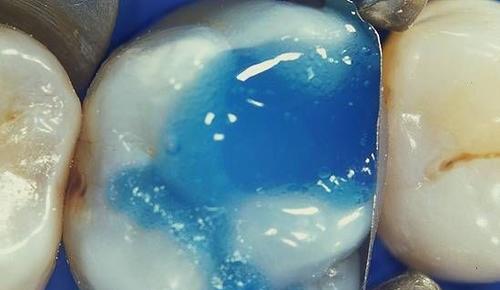 补牙太贵了五百块,补牙有300多和200多的差别在哪里