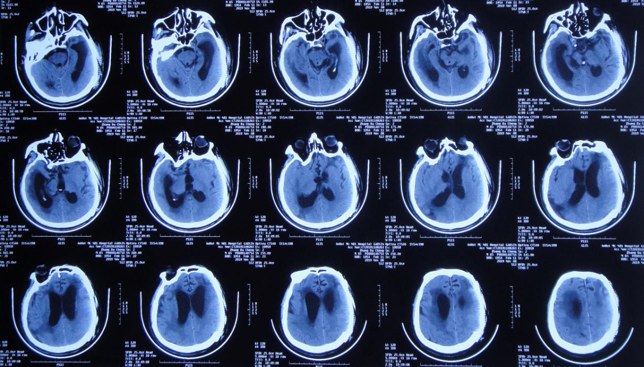 颅脑外伤术后脑积水,脑外伤脑积水颅骨缺失