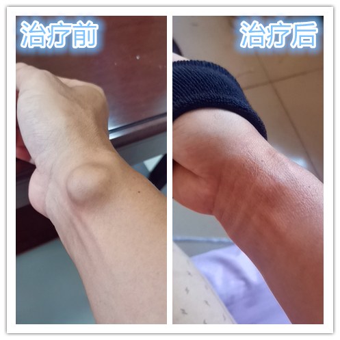 腱鞘囊肿开刀会留多大的疤,手腕腱鞘囊肿开刀的流程